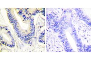 Peptide - +Immunohistochemistry analysis of paraffin-embedded human colon carcinoma tissue using IRS-1 antibody. (IRS1 antibody  (Internal Region))