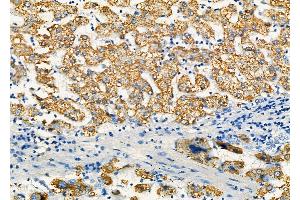 ABIN6259881 and ABIN6277303 at 1/100 staining Human liver cancer and adjacent normal tissues by IHC-P. (ALDH4A1 antibody  (C-Term))