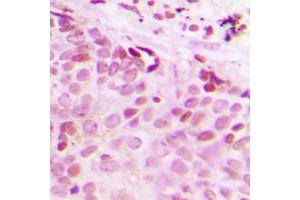 Immunohistochemical analysis of Separase (pS801) staining in human breast cancer formalin fixed paraffin embedded tissue section. (Separase antibody  (pSer801))