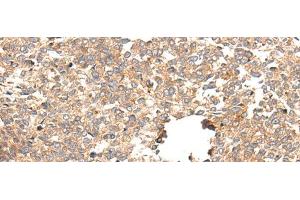 Immunohistochemistry of paraffin-embedded Human esophagus cancer tissue using CACNG5 Polyclonal Antibody at dilution of 1:50(x200) (CACNG5 antibody)