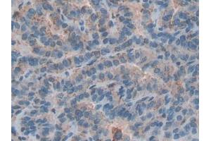 DAB staining on IHC-P; Samples: Human Thyroid cancer Tissue (Cathepsin D antibody  (AA 169-408))