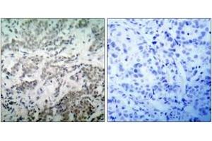 Immunohistochemistry analysis of paraffin-embedded human breast carcinoma tissue, using p53 (Ab-15) Antibody. (p53 antibody  (AA 6-55))