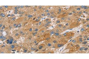 Immunohistochemistry of paraffin-embedded Human liver cancer tissue using ST18 Polyclonal Antibody at dilution 1:50 (ST18 antibody)
