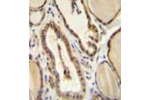 Immunohistochemistry analysis in formalin fixed and paraffin embedded human thyroid tissue reacted with GUCY2D / GUCY2D / RETGC1 Antibody (Center) followed which was peroxidase conjugated to the secondary antibody and followed by DAB staining. (GUCY2D antibody  (Middle Region))
