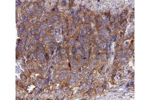 Immunohistochemistry analysis of RANTES antibody in paraffin-embedded human lung carcinoma tissue (CCL5 antibody  (Internal Region))