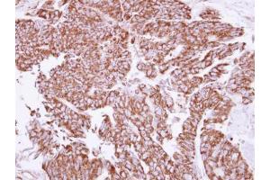 IHC-P Image Immunohistochemical analysis of paraffin-embedded human colon carcinoma, using Angiopoietin 2, antibody at 1:250 dilution. (Angiopoietin 2 antibody)