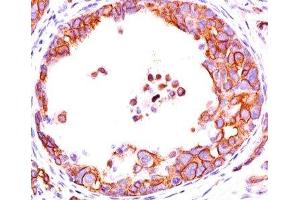 IHC testing of breast DCIS (ductal carcinoma in situ) stained with HER2 antibody (HRB2/451). (ErbB2/Her2 antibody)