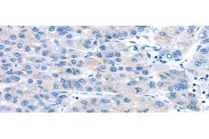 Immunohistochemistry of paraffin-embedded Human liver cancer using UCP2 Polyclonal Antibody at dilution of 1/20 (UCP2 antibody)