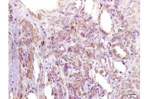 Formalin-fixed and paraffin embedded human cervical carcinoma labeled with Anti-IGFBP2 Polyclonal Antibody, Unconjugated (ABIN737781) at 1:200 followed by conjugation to the secondary antibody and DAB staining. (IGFBP2 antibody  (AA 101-200))