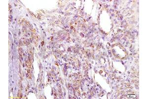 Formalin-fixed and paraffin embedded human cervical carcinoma labeled with Anti-IGFBP2 Polyclonal Antibody, Unconjugated (ABIN737781) at 1:200 followed by conjugation to the secondary antibody and DAB staining. (IGFBP2 antibody  (AA 101-200))