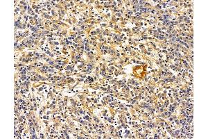 ABIN7095709 and ABIN7099771 at 1/100 staining human gastric cancer by IHC-P. (ALAD antibody)