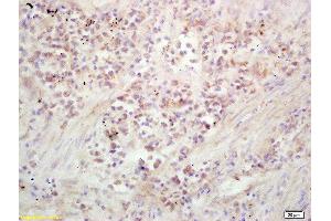 Formalin-fixed and paraffin embedded human lung carcinoma labeled with Rabbit Anti Kinesin Polyclonal Antibody, Unconjugated  at 1:200 followed by conjugation to the secondary antibody and DAB staining (Kinesin antibody  (AA 561-660))