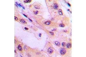 Immunohistochemical analysis of ACK1 (pY284) staining in human lung cancer formalin fixed paraffin embedded tissue section.