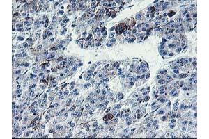 Immunohistochemical staining of paraffin-embedded Carcinoma of Human liver tissue using anti-PVRL1 mouse monoclonal antibody.