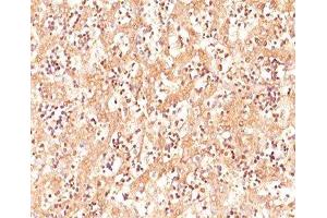 IHC testing of human fetal liver stained with AFP antibody (C3). (alpha Fetoprotein antibody)
