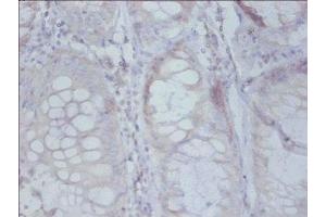 Immunohistochemistry of paraffin-embedded human colon cancer using ABIN7142508 at dilution of 1: 50 (RPS19 antibody  (AA 1-145))