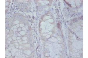 Immunohistochemistry of paraffin-embedded human colon cancer using ABIN7142508 at dilution of 1: 50