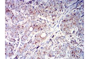 Immunohistochemical analysis of paraffin-embedded cervical cancer tissues using CD63 mouse mAb with DAB staining. (CD63 antibody  (AA 103-203))