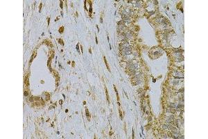 Immunohistochemistry of paraffin-embedded Human liver cancer using CDA Polyclonal Antibody at dilution of 1:100 (40x lens).