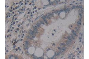 Detection of MMP14 in Human Colorectal cancer Tissue using Polyclonal Antibody to Matrix Metalloproteinase 14 (MMP14) (MMP14 antibody  (AA 322-541))