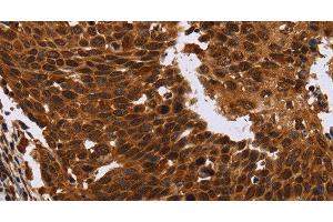 Immunohistochemistry of paraffin-embedded Human cervical cancer tissue using FANCF Polyclonal Antibody at dilution 1:60 (FANCF antibody)