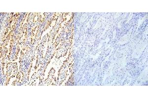 Immunohistochemical analysis of paraffin- embedded human lung carcinoma tissue using LKB1 (Ab-334) antibody (E022045). (LKB1 antibody)