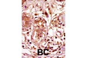 Formalin-fixed and paraffin-embedded human cancer tissue reacted with the primary antibody, which was peroxidase-conjugated to the secondary antibody, followed by AEC staining. (BUB1 antibody  (C-Term))