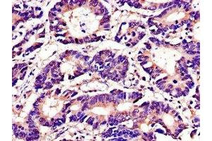 Immunohistochemistry of paraffin-embedded human colon cancer using ABIN7173671 at dilution of 1:100 (TUBA4A antibody  (AA 20-183))