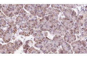 ABIN6273237 at 1/100 staining Human pancreas cancer tissue by IHC-P. (EIF3I antibody  (C-Term))