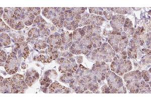 ABIN6273237 at 1/100 staining Human pancreas cancer tissue by IHC-P. (EIF3I antibody  (C-Term))