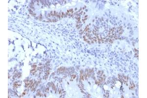 Formalin-fixed, paraffin-embedded human Colon Carcinoma stained with Retinoblastoma Recombinant Rabbit Monoclonal Antibody (RB1/2313R). (Recombinant Retinoblastoma 1 antibody)