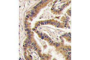 Formalin-fixed and paraffin-embedded human lung carcinoma tissue reacted with CK1a antibody (C-term), which was peroxidase-conjugated to the secondary antibody, followed by DAB staining. (CSNK1A1 antibody  (C-Term))