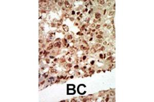 Formalin-fixed and paraffin-embedded human cancer tissue reacted with MAPK11 polyclonal antibody  , which was peroxidase-conjugated to the secondary antibody, followed by AEC staining. (MAPK11 antibody  (Internal Region))