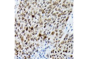 Immunohistochemistry of paraffin-embedded human lung cancer using Phospho-FOXO3A-S425 Rabbit pAb (ABIN7267246) at dilution of 1:250 (40x lens). (FOXO3 antibody  (pSer425))