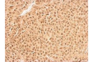 IHC-P Image RPL11 antibody detects RPL11 protein at cytosol and nucleus on HeLa xenograft by immunohistochemical analysis. (RPL11 antibody)