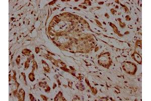 IHC image of ABIN7157636 diluted at 1:100 and staining in paraffin-embedded human pancreatic cancer performed on a Leica BondTM system. (KIF25 antibody  (AA 1-262))