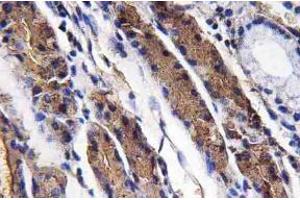 Immunohistochemistry analysis of Pepsin A Antibody in paraffin-embedded human lung carcinoma tissue. (Pepsin antibody)