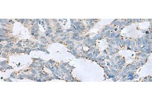Immunohistochemistry of paraffin-embedded Human colorectal cancer tissue using GPR6 Polyclonal Antibody at dilution of 1:80(x200) (GPR6 antibody)