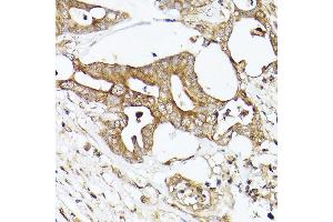 Immunohistochemistry of paraffin-embedded human colon carcinoma using  Rabbit pAb (ABIN7265370) at dilution of 1:50 (40x lens). (Acetyl-CoA Carboxylase alpha antibody)
