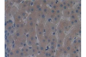 Detection of DBP in Human Liver cancer Tissue using Polyclonal Antibody to Vitamin D Binding Protein (DBP) (Vitamin D-Binding Protein antibody  (AA 395-474))