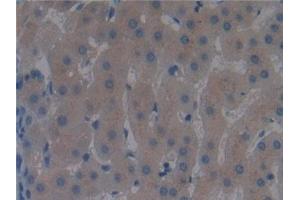 Detection of DBP in Human Liver cancer Tissue using Polyclonal Antibody to Vitamin D Binding Protein (DBP) (Vitamin D-Binding Protein antibody  (AA 395-474))