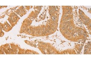 Immunohistochemistry of paraffin-embedded Human colon cancer using AK2 Polyclonal Antibody at dilution of 1:40 (Adenylate Kinase 2 antibody)