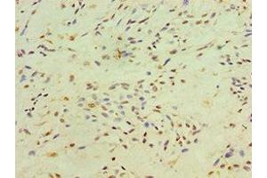 Immunohistochemistry of paraffin-embedded human breast cancer using ABIN7150305 at dilution of 1:100 (XRCC4 antibody  (AA 1-336))