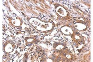 IHC-P Image MC1 Receptor antibody [C2C3], C-term detects MC1R protein at cytosol and membrane on human colon carcinoma by immunohistochemical analysis. (MC1 Receptor antibody  (C-Term))