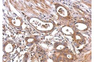IHC-P Image MC1 Receptor antibody [C2C3], C-term detects MC1R protein at cytosol and membrane on human colon carcinoma by immunohistochemical analysis.