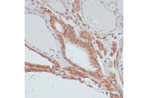 Immunohistochemistry of paraffin-embedded human thyroid cancer using MYCBP antibody (ABIN1680940, ABIN3019105, ABIN3019106 and ABIN6220717) at dilution of 1:100 (40x lens). (MYCBP antibody  (AA 1-103))