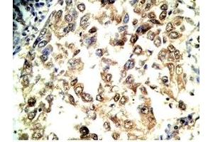 Human lung cancer tissue stained by Rabbit Anti-Adrenomedullin Gly (Human) Antibody (Adrenomedullin-Gly antibody)