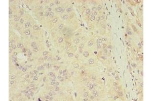 Immunohistochemistry of paraffin-embedded human liver cancer using ABIN7144179 at dilution of 1:100 (ASB11 antibody  (AA 41-315))