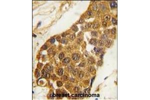 Formalin-fixed and paraffin-embedded human breast carcinoma tissue reacted with Msx2 Antibody (C-term) (ABIN1881555 and ABIN2839326) , which was peroxidase-conjugated to the secondary antibody, followed by DAB staining. (Msx2/Hox8 antibody  (C-Term))