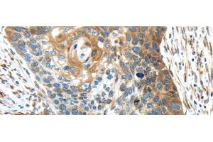 Immunohistochemistry of paraffin-embedded Human esophagus cancer using TMED4 Polyclonal Antibody at dilution of 1/45 (TMED4 antibody)
